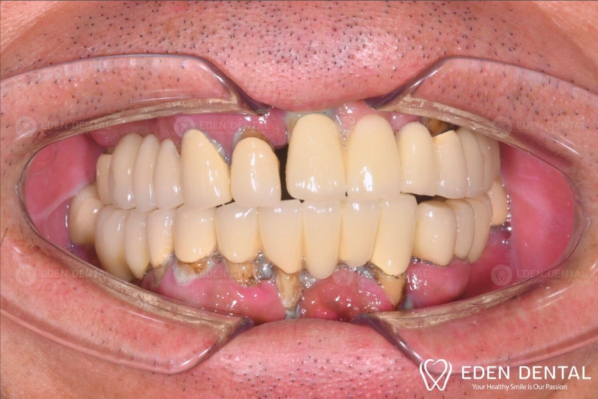 Before All-on-4 Implants