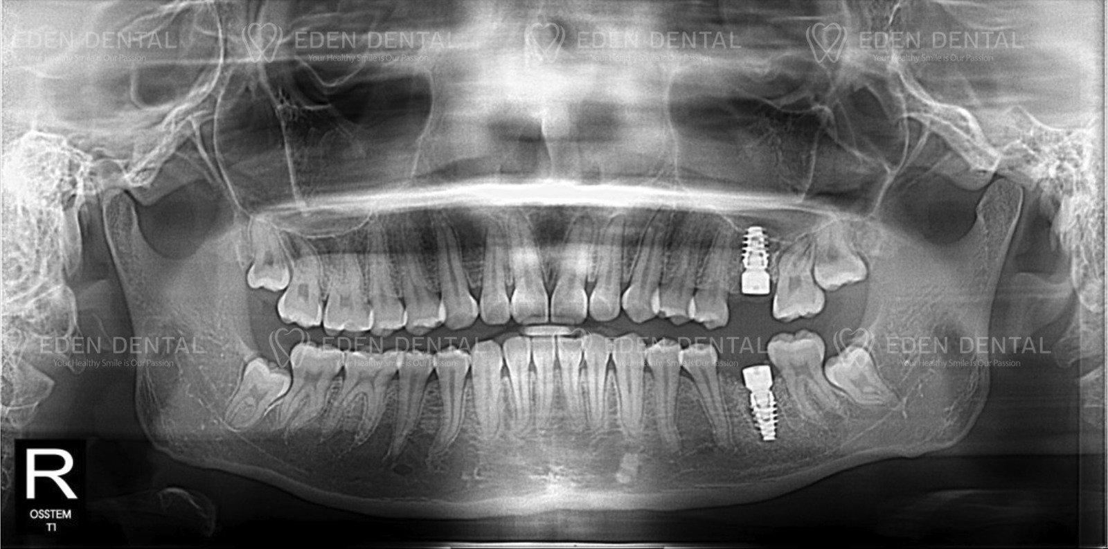 After One Day Implant