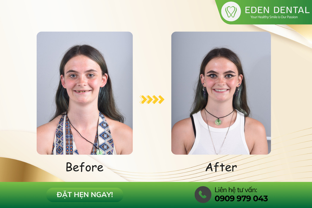 Dental implant results